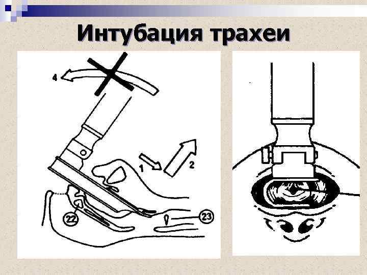 Интубация трахеи 