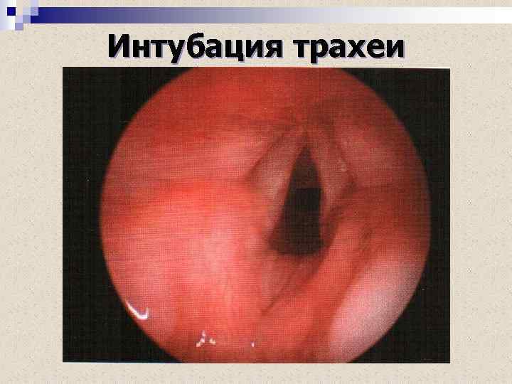 Интубация трахеи 