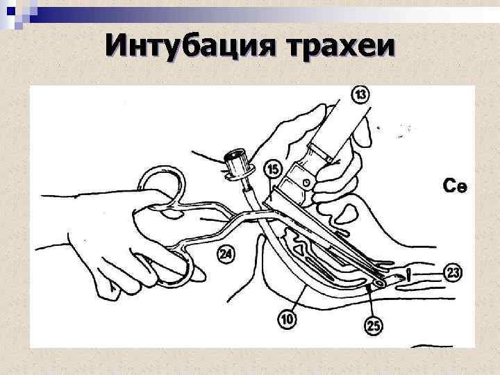 Интубация трахеи 