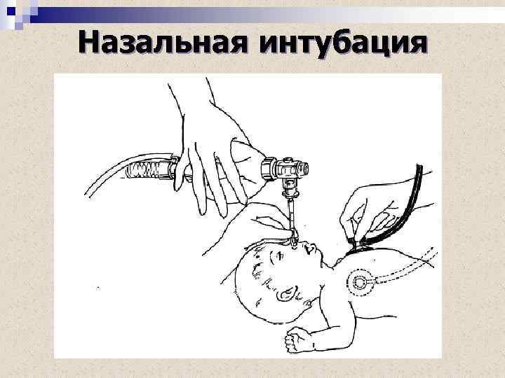 Назальная интубация 