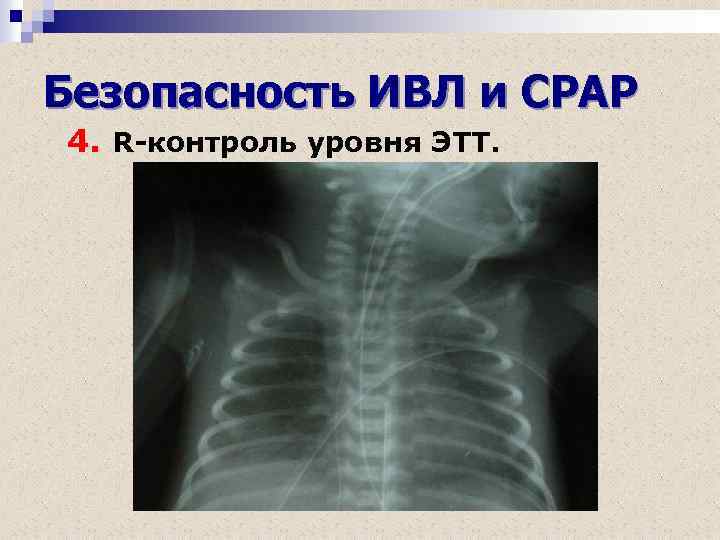 Безопасность ИВЛ и СРАР 4. R-контроль уровня ЭТТ. 