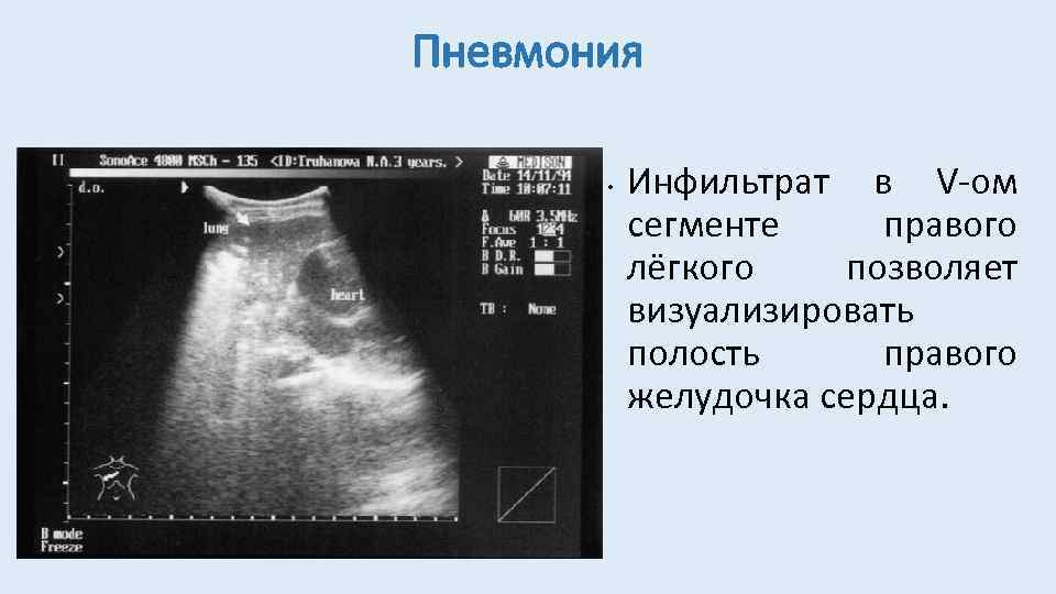Пневмония • Инфильтрат в V-ом сегменте правого лёгкого позволяет визуализировать полость правого желудочка сердца.