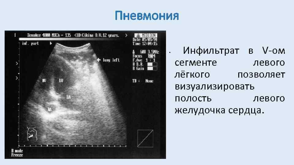 Пневмония • Инфильтрат в V-ом сегменте левого лёгкого позволяет визуализировать полость левого желудочка сердца.