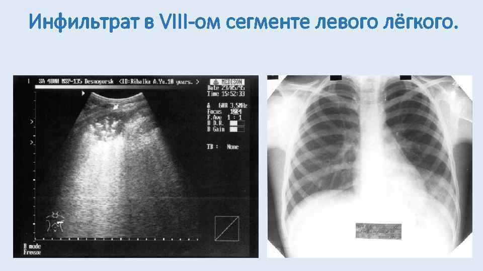 Инфильтрат в VIII-ом сегменте левого лёгкого. 