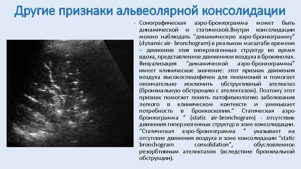 Другие признаки альвеолярной консолидации • Сонографическая аэро-бронхограмма может быть динамической и статической. Внутри консолидации
