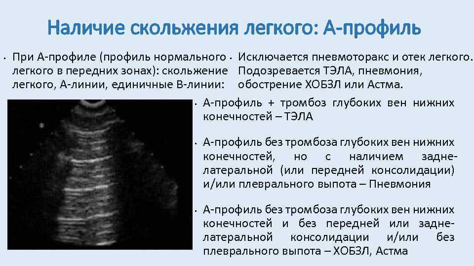 Наличие скольжения легкого: А-профиль • При А-профиле (профиль нормального • Исключается пневмоторакс и отек