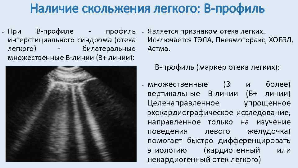 Наличие скольжения легкого: В-профиль • При В-профиле профиль интерстициального синдрома (отека легкого) билатеральные множественные