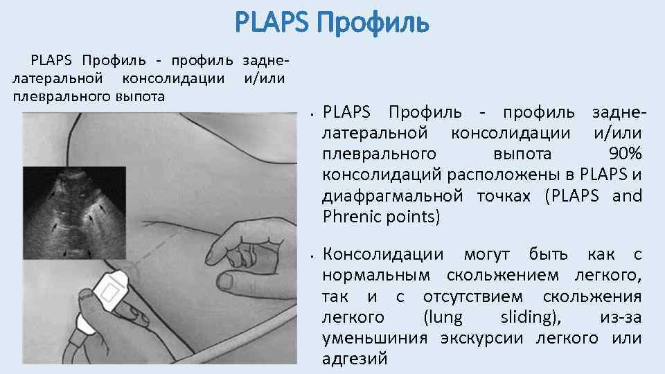 PLAPS Профиль - профиль заднелатеральной консолидации и/или плеврального выпота • • PLAPS Профиль -