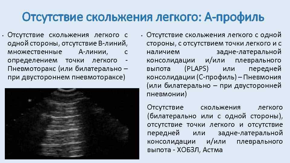 УЗИ легких пневмоторакс. Пневмоторакс на УЗИ. Пневмоторакс на УЗИ признаки. Консолидация легкого на УЗИ.