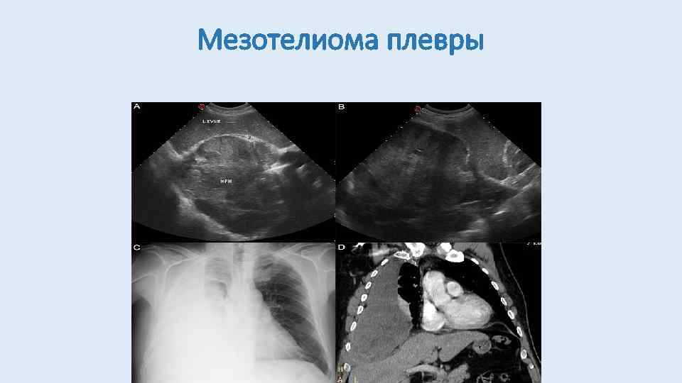 Ультразвуковое изображение серозоцеле представлено