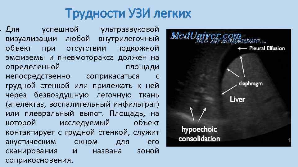 Трудности УЗИ легких • Для успешной ультразвуковой визуализации любой внутрилегочный объект при отсутствии подкожной