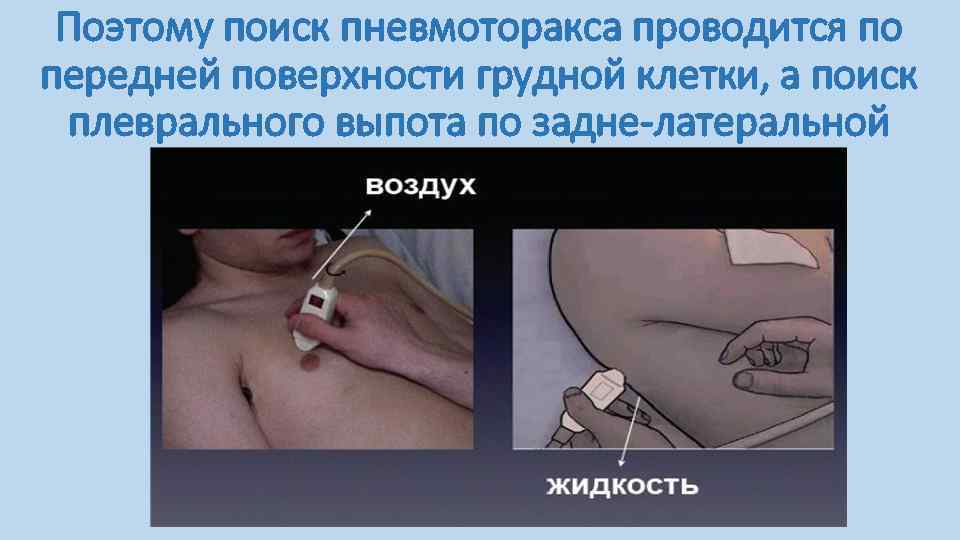 Поэтому поиск пневмоторакса проводится по передней поверхности грудной клетки, а поиск плеврального выпота по