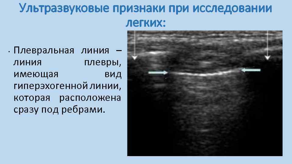 Жидкость в плевральной полости на узи фото