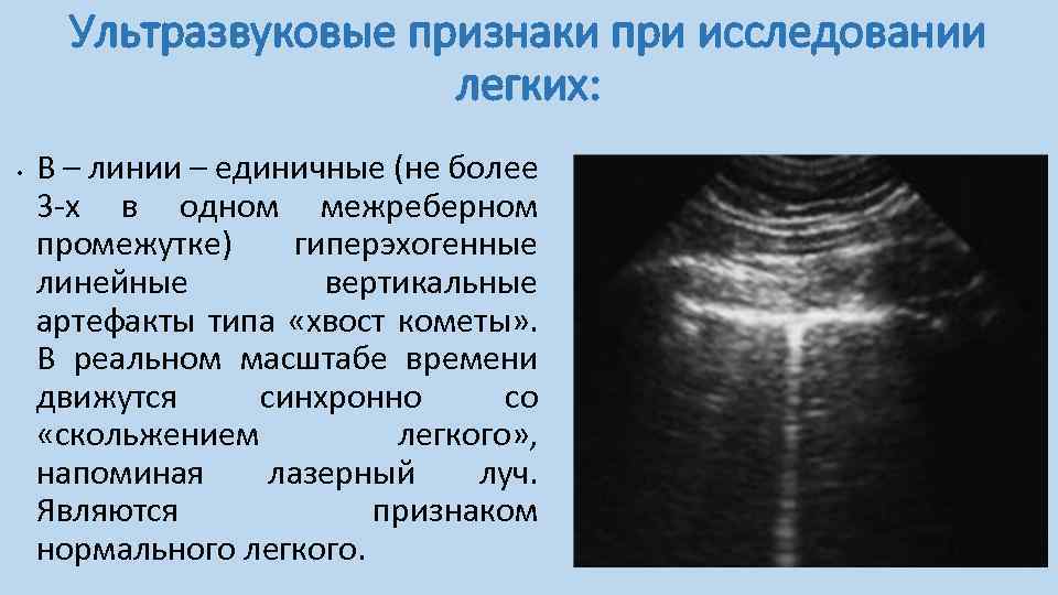 На эхограммах грудной стенки ребра имеют вид