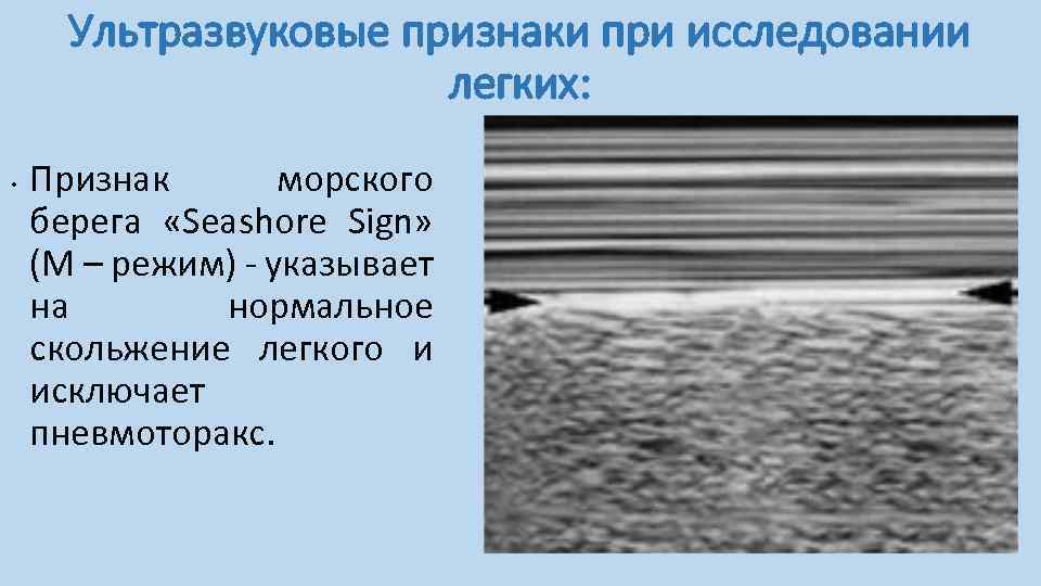 Ультразвуковые признаки при исследовании легких: • Признак морского берега «Seashore Sign» (М – режим)