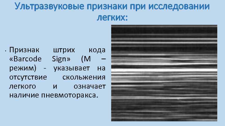 Ультразвуковые признаки при исследовании легких: • Признак штрих кода «Вarcode Sign» (М – режим)