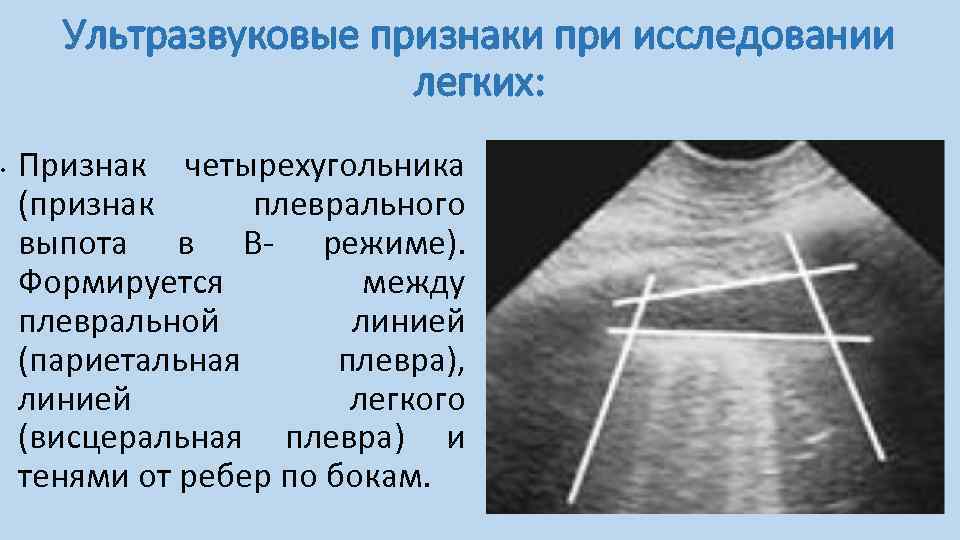 Узи легких что показывает. Протокол УЗИ плевральных полостей и легких. УЗИ плевральной полости заключение протокол. Протокол УЗИ плевральных полостей гидроторакс. Плевральные выпот УЗИ протокол.