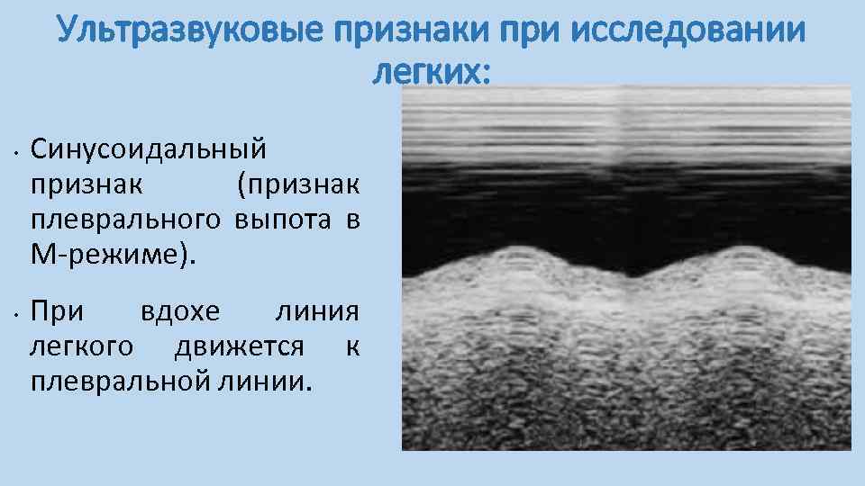 Ультразвуковые признаки при исследовании легких: • • Синусоидальный признак (признак плеврального выпота в М-режиме).