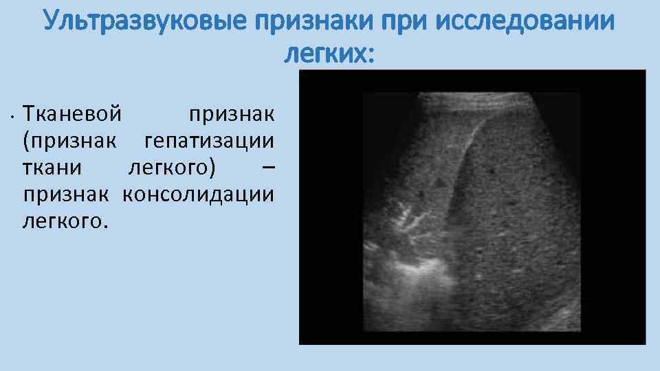 Ультразвуковые признаки при исследовании легких: • Тканевой признак (признак гепатизации ткани легкого) – признак