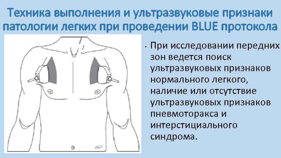 Техника выполнения и ультразвуковые признаки патологии легких при проведении BLUE протокола • При исследовании
