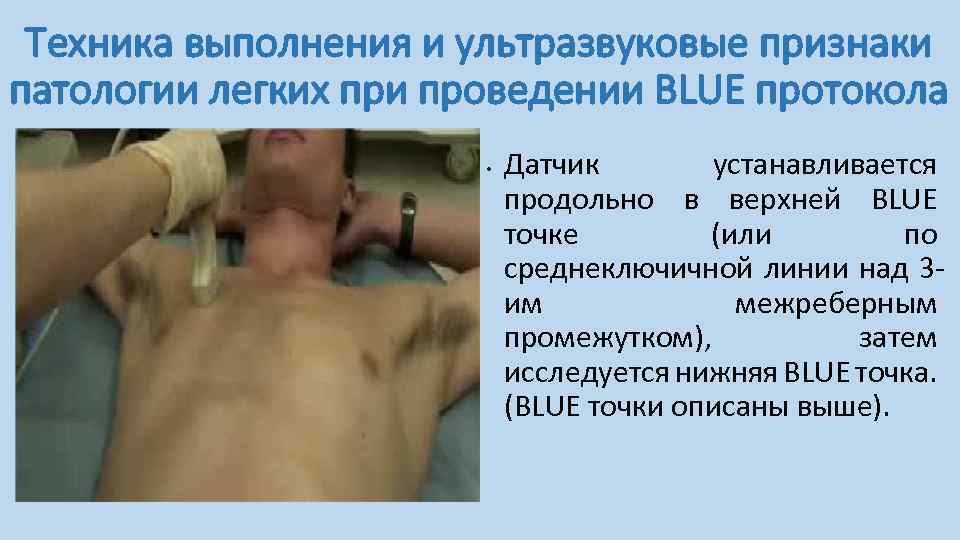 Техника выполнения и ультразвуковые признаки патологии легких при проведении BLUE протокола • Датчик устанавливается