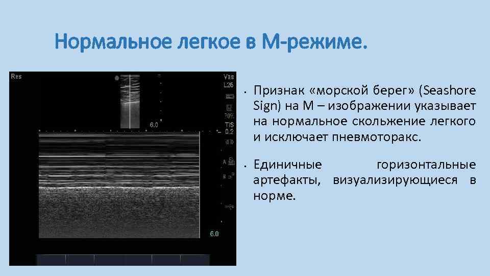 Нормальное легкое в М-режиме. • • Признак «морской берег» (Seashore Sign) на М –