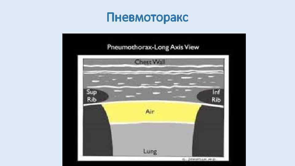 Пневмоторакс 