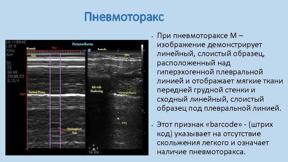 Карта смп пневмоторакс