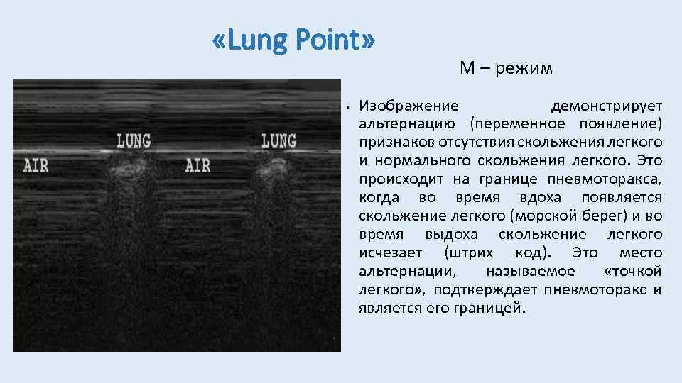  «Lung Point» • М – режим Изображение демонстрирует альтернацию (переменное появление) признаков отсутствия