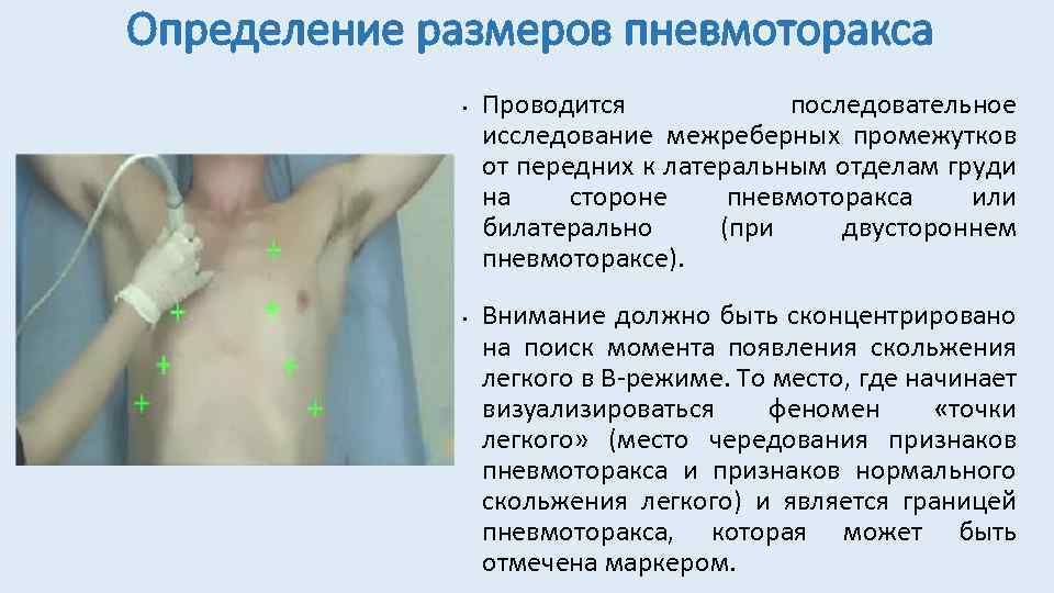 Определение размеров пневмоторакса • • Проводится последовательное исследование межреберных промежутков от передних к латеральным
