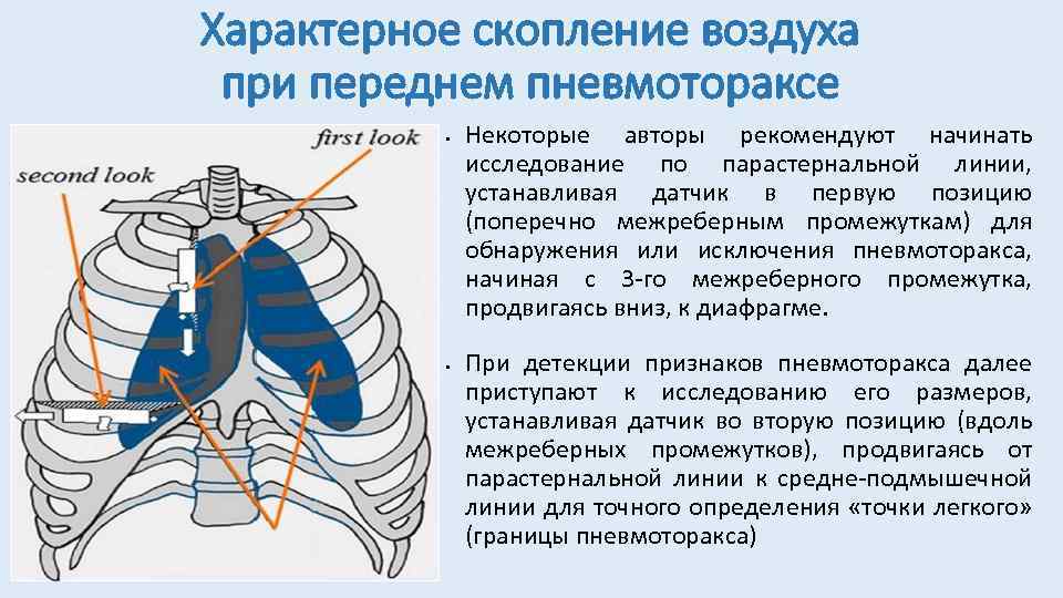 Характерное скопление воздуха при переднем пневмотораксе • • Некоторые авторы рекомендуют начинать исследование по