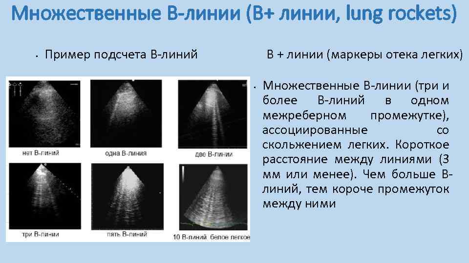 Множественные В-линии (В+ линии, lung rockets) • Пример подсчета В-линий В + линии (маркеры