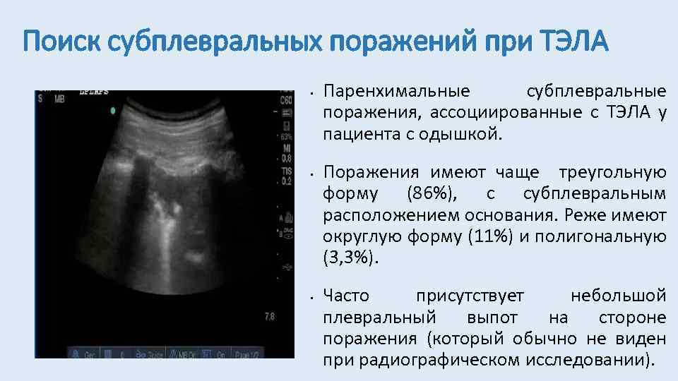 Поиск субплевральных поражений при ТЭЛА • • • Паренхимальные субплевральные поражения, ассоциированные с ТЭЛА