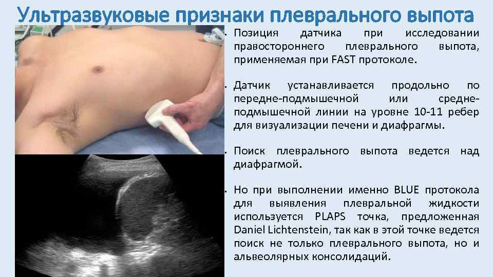 Ультразвуковые признаки плеврального выпота • • Позиция датчика при исследовании правостороннего плеврального выпота, применяемая