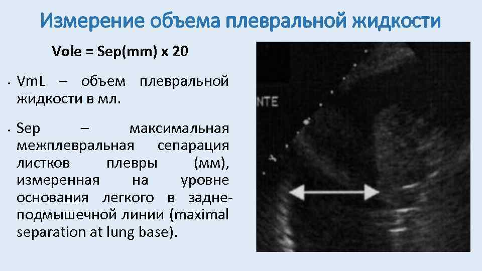 Измерение объема плевральной жидкости Vole = Sep(mm) x 20 • • Vm. L –