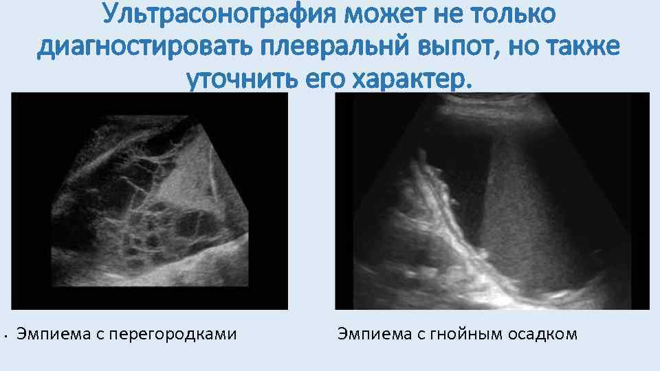 Ультрасонография может не только диагностировать плевральнй выпот, но также уточнить его характер. • Эмпиема