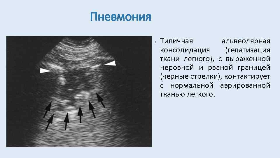 Пневмония • Типичная альвеолярная консолидация (гепатизация ткани легкого), с выраженной неровной и рваной границей