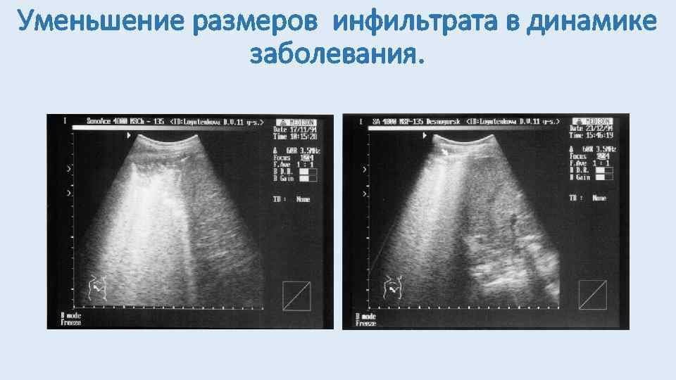 Уменьшение размеров инфильтрата в динамике заболевания. 