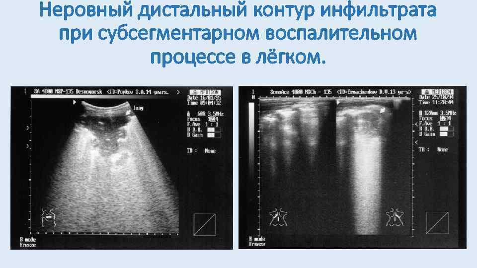 Неровный дистальный контур инфильтрата при субсегментарном воспалительном процессе в лёгком. 