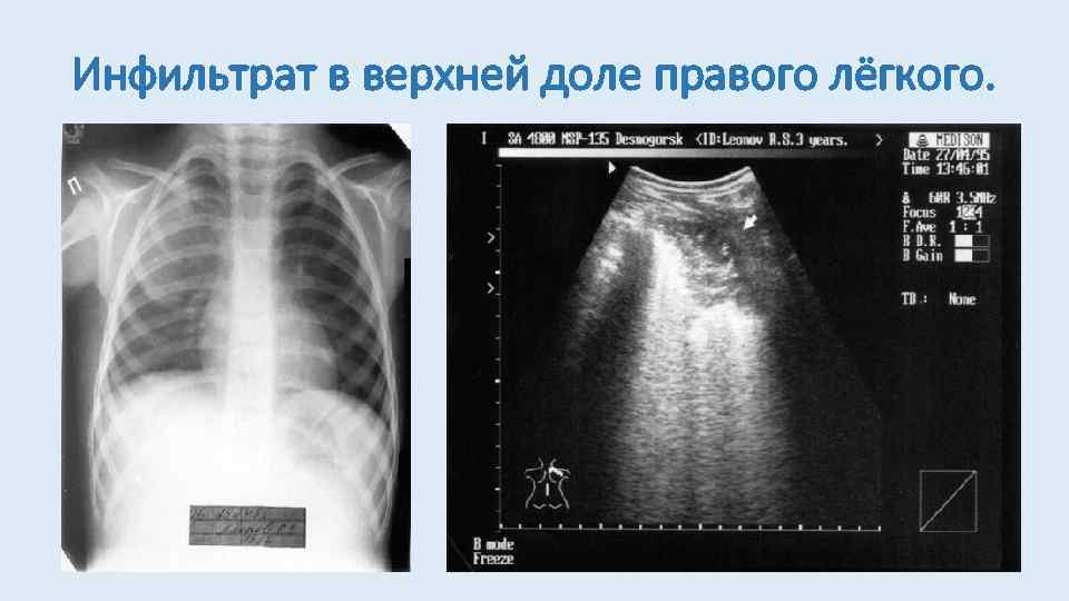Инфильтрат в верхней доле правого лёгкого. 