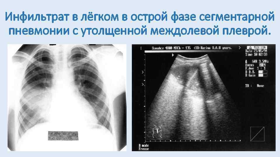 Инфильтрат в лёгком в острой фазе сегментарной пневмонии с утолщенной междолевой плеврой. 