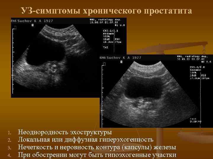 УЗ-симптомы хронического простатита 1. 2. 3. 4. Неоднородность эхоструктуры Локальная или диффузная гиперэхогенность Нечеткость