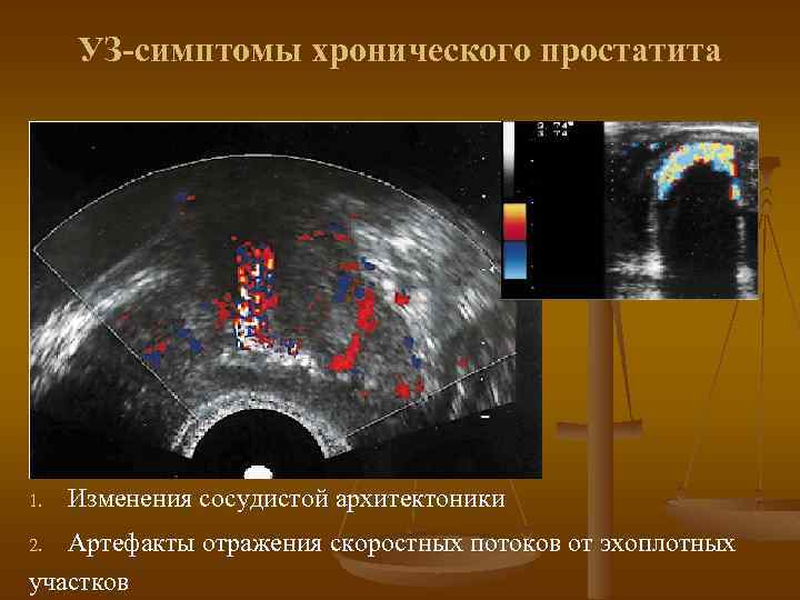 УЗ-симптомы хронического простатита 1. Изменения сосудистой архитектоники Артефакты отражения скоростных потоков от эхоплотных участков