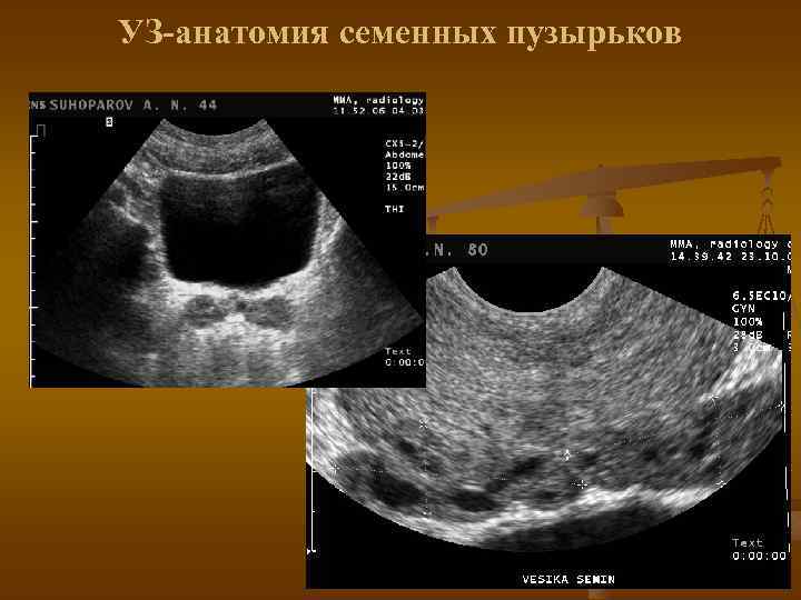 УЗ-анатомия семенных пузырьков 