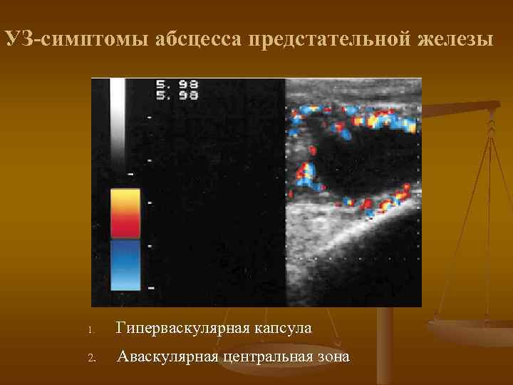 УЗ-симптомы абсцесса предстательной железы 1. Гиперваскулярная капсула 2. Аваскулярная центральная зона 