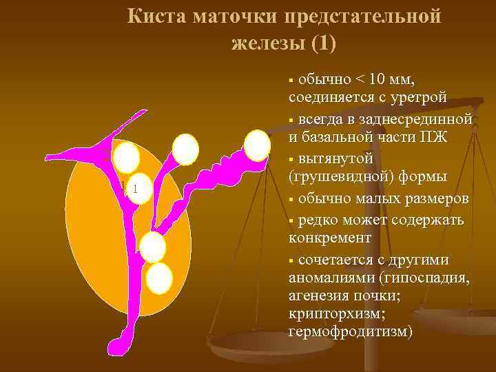 Киста маточки предстательной железы (1) обычно < 10 мм, соединяется с уретрой § всегда