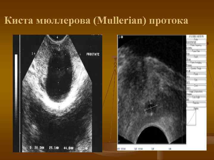 Киста мюллерова (Mullerian) протока 