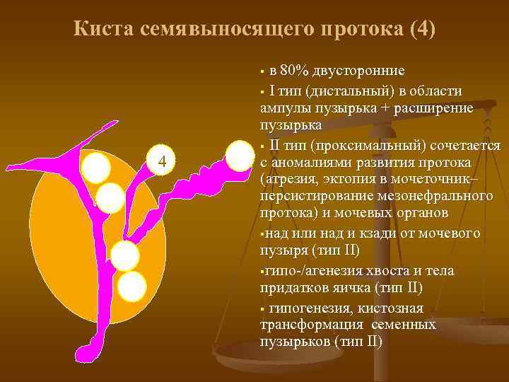 Киста семявыносящего протока (4) в 80% двусторонние § I тип (дистальный) в области ампулы