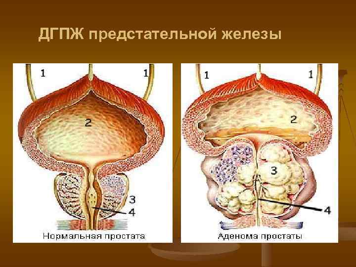 Степени гиперплазии предстательной железы