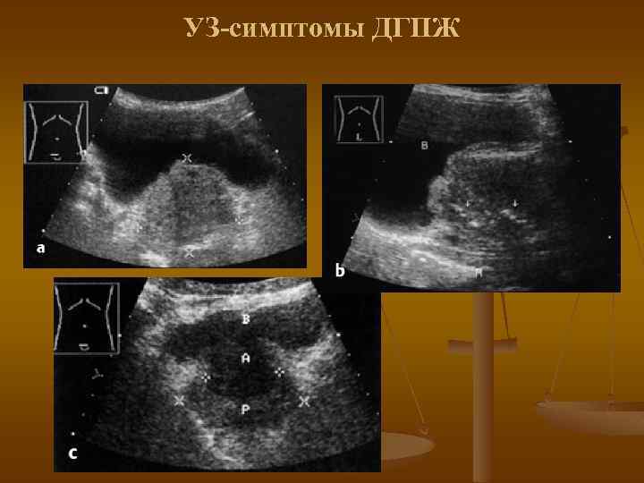 УЗ-симптомы ДГПЖ 